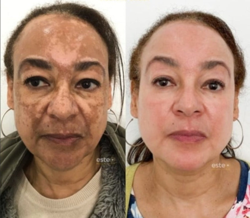 ClareSkin 577 — Spray Removedor de Manchas, Sol, Idade e Melasma! 50% DE DESCONTO + FRETE GRÁTIS!