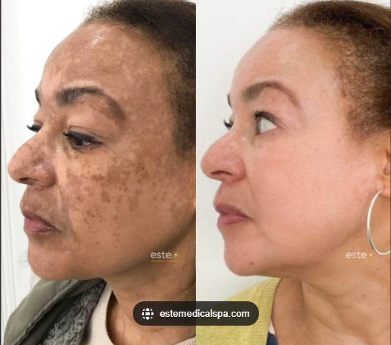 ClareSkin 577 — Spray Removedor de Manchas, Sol, Idade e Melasma! 50% DE DESCONTO + FRETE GRÁTIS!