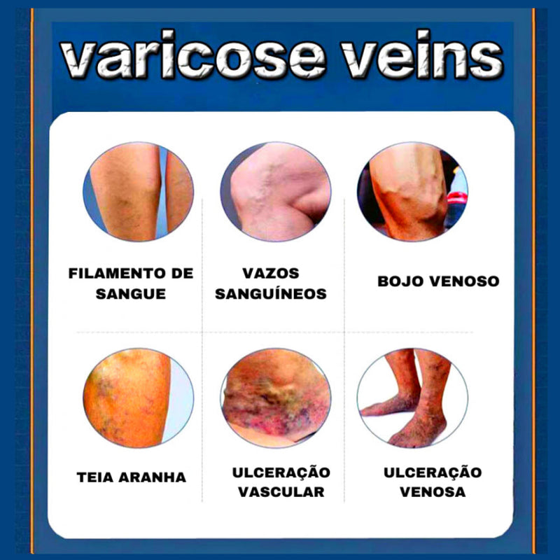 O Creme Poderoso Contra Varizes! Promoção: 50% de Desconto + Frete Grátis!