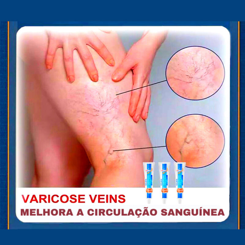 O Creme Poderoso Contra Varizes! Promoção: 50% de Desconto + Frete Grátis!