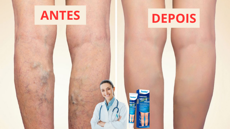 O Creme Poderoso Contra Varizes! Promoção: 50% de Desconto + Frete Grátis!