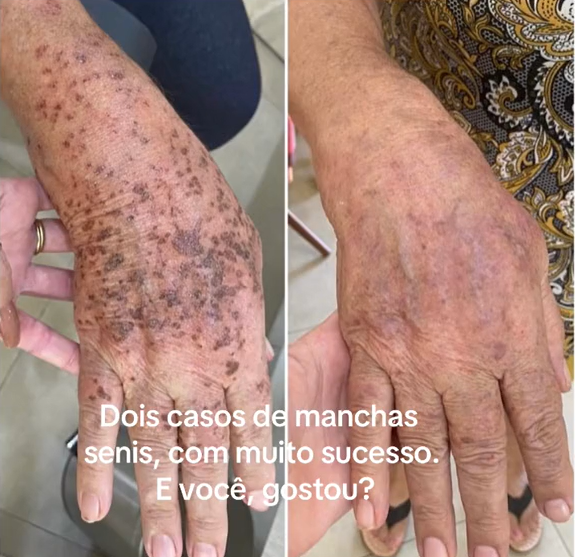 Máscara para as Mãos - RtopR - Acaba com manchas de idade. 50% DE DESCONTO + FRETE GRÁTIS